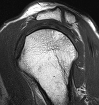 Os Acromionale MRI Sagittal